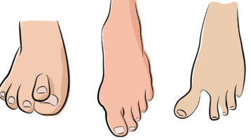 abnormal feet